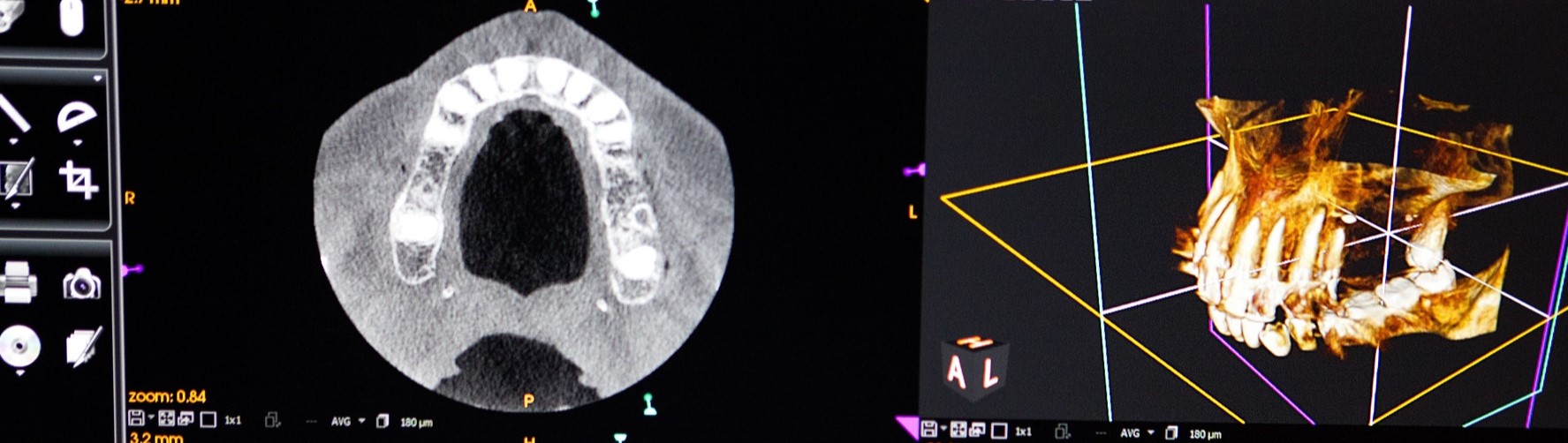 diagnostyka obrazowa zebow w Bielany Dental, tomografia komputerowa uzębienia